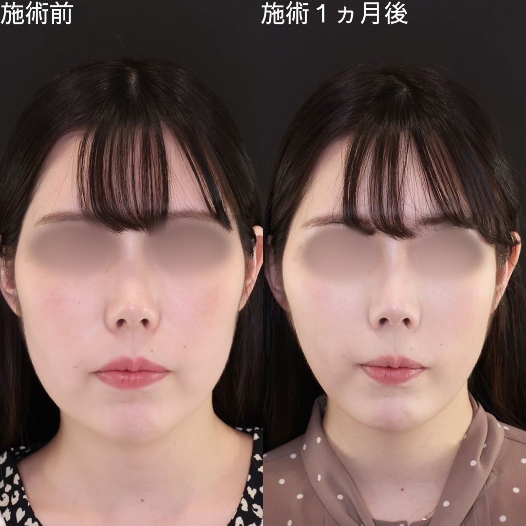 【小顔複合術】Dr.石橋の垢抜け小顔術