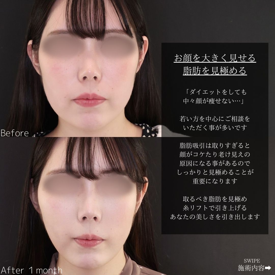 TAC式 ツヤ肌コラーゲンリフト®/ジョールファット除去/Lラインファット除去（エラ下脂肪除去）の症例写真 施術前後 