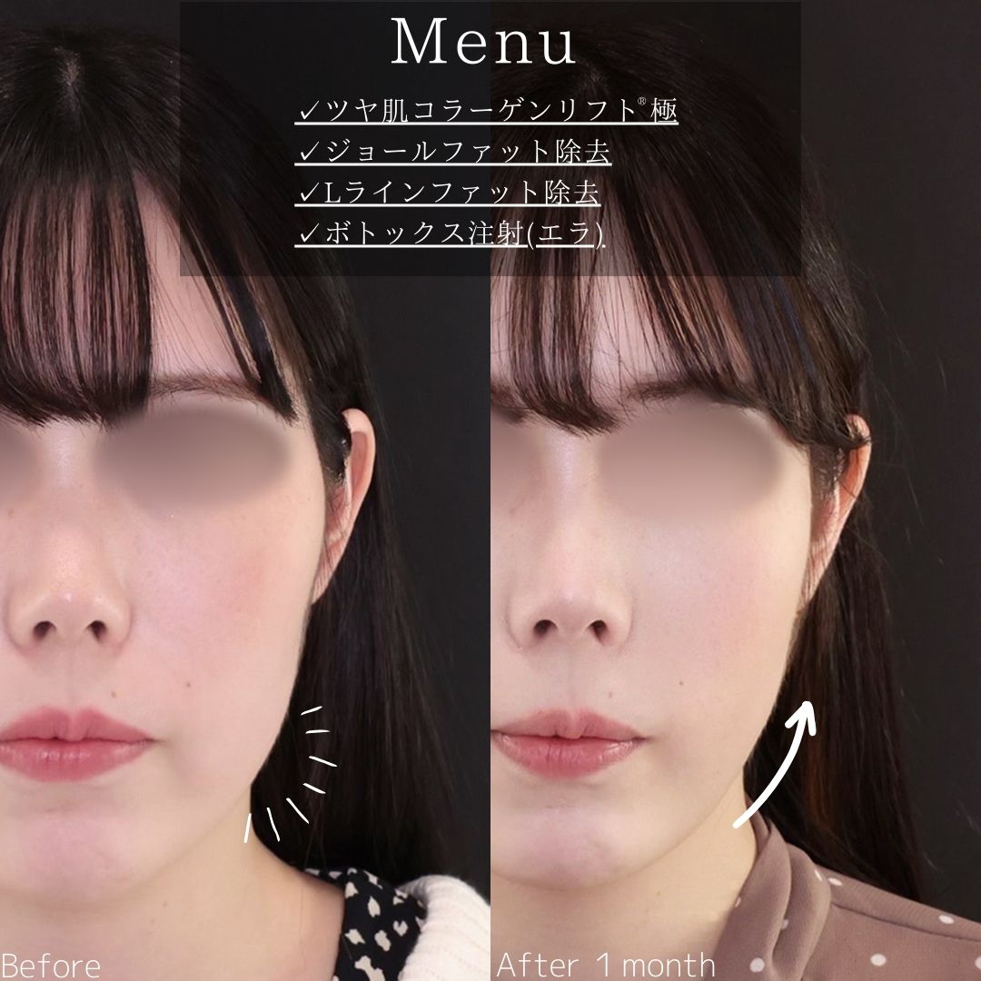TAC式 ツヤ肌コラーゲンリフト®/ジョールファット除去/Lラインファット除去（エラ下脂肪除去）の症例写真 施術前後 