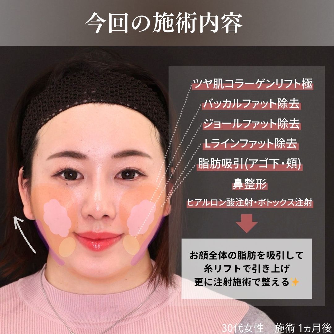 TAC式 ツヤ肌コラーゲンリフト®/顔の脂肪吸引/バッカルファット除去の症例写真 施術前後