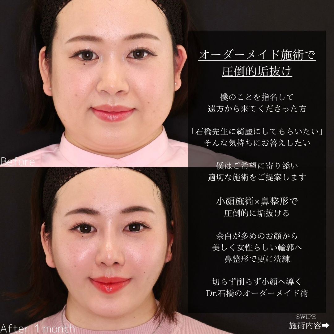 TAC式 ツヤ肌コラーゲンリフト®/顔の脂肪吸引/バッカルファット除去の症例写真 施術前後