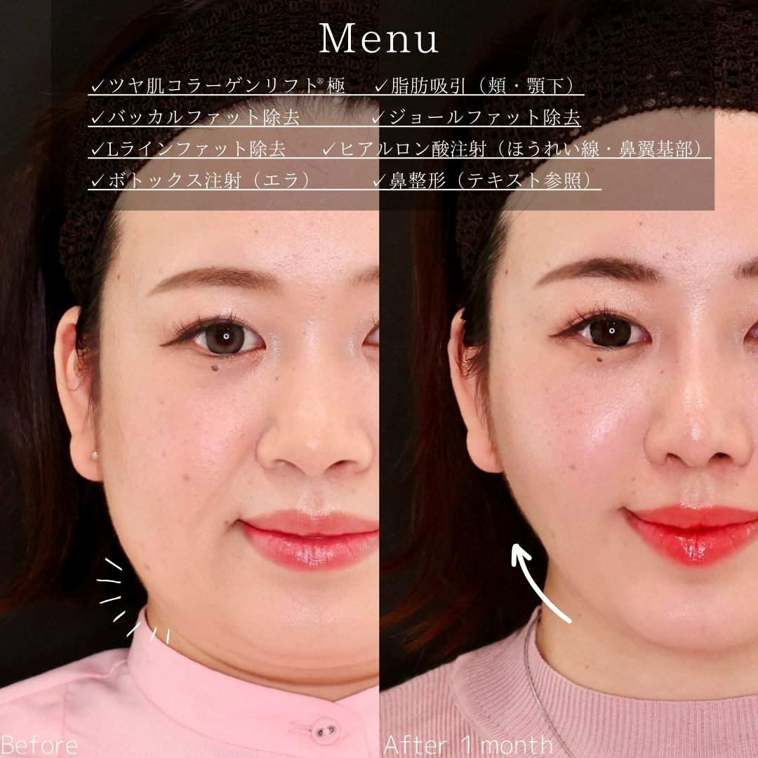 TAC式 ツヤ肌コラーゲンリフト®/顔の脂肪吸引/バッカルファット除去の症例写真 施術前後