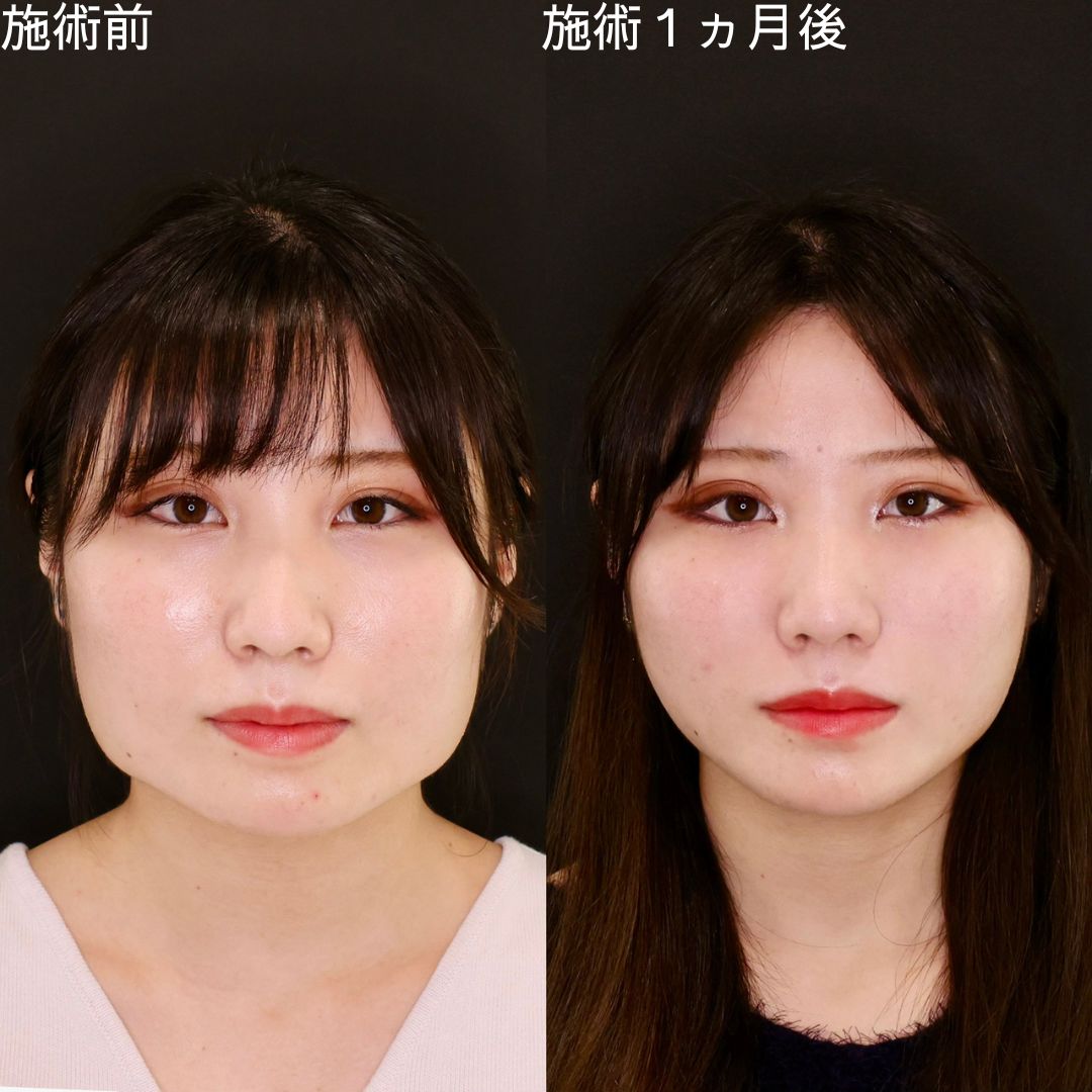 骨切り無しで輪郭を洗練Dr.石橋の小顔術【小顔複合施術】
