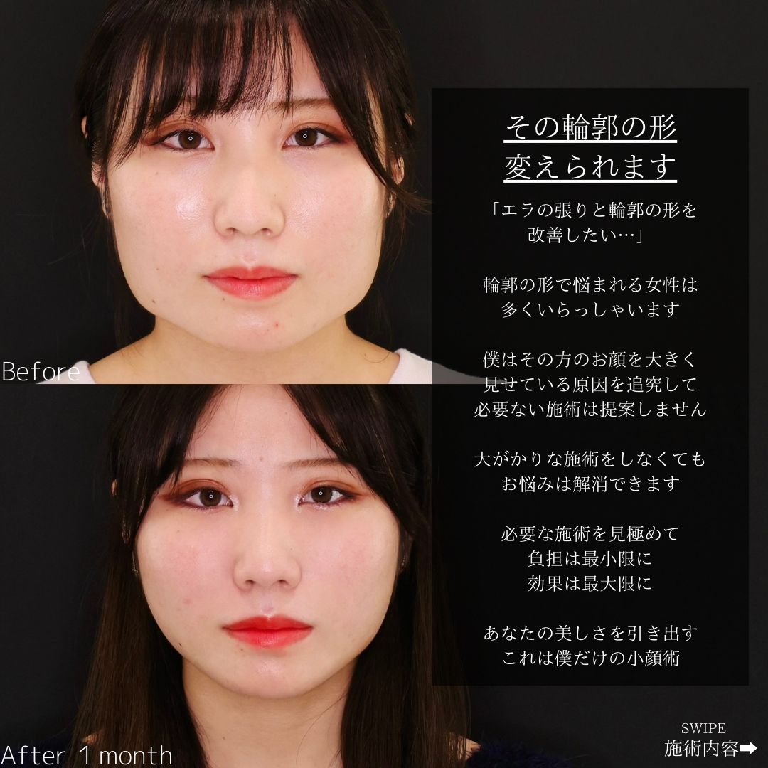 TAC式 ツヤ肌コラーゲンリフト®/顔の脂肪吸引/エラボトックス注射の症例写真 施術前後