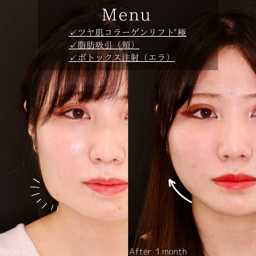 TAC式 ツヤ肌コラーゲンリフト®/顔の脂肪吸引/エラボトックス注射の症例写真 施術前後