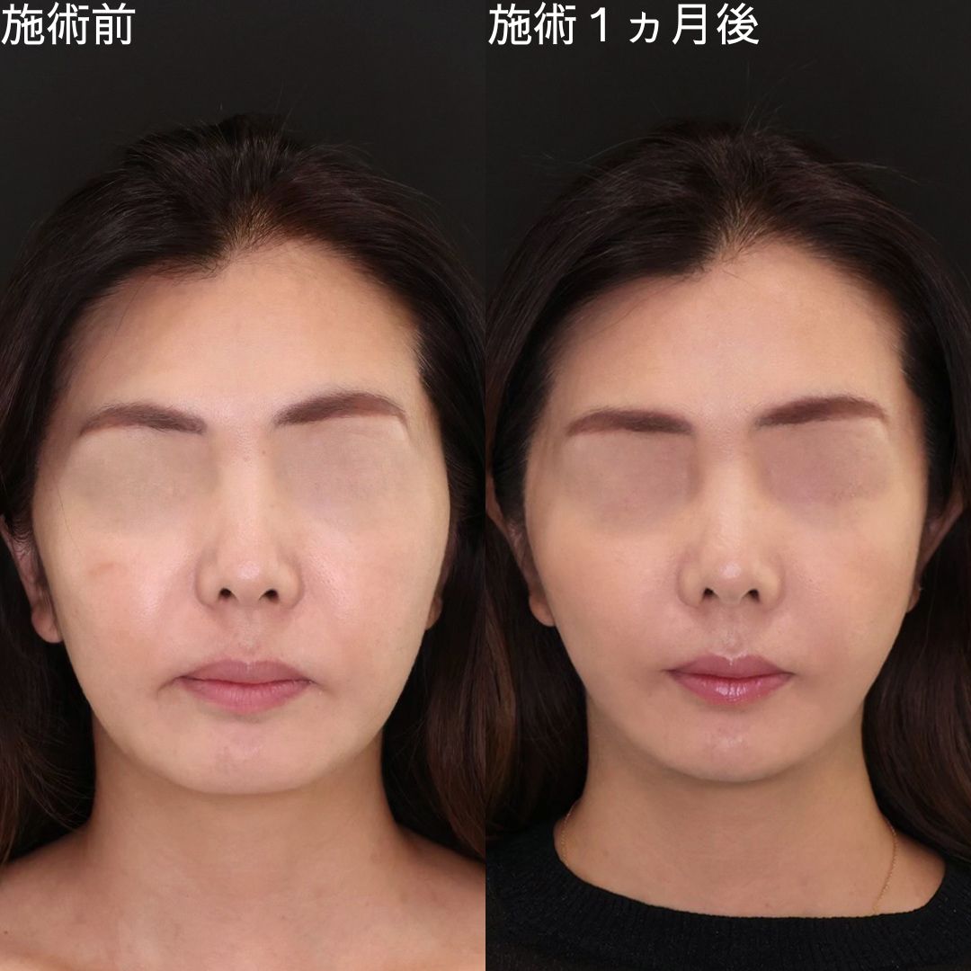 【小顔複合術】40代の印象を変える小顔術