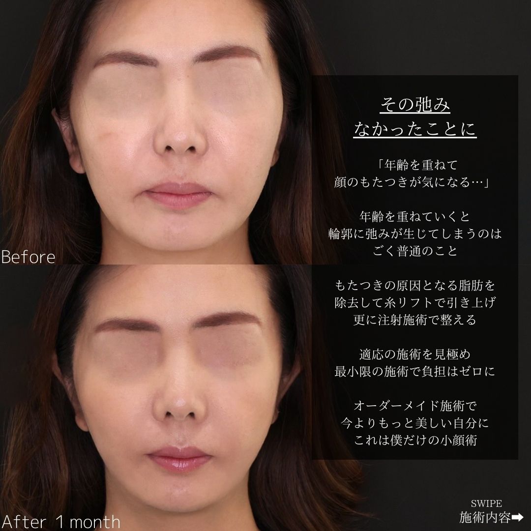 TAC式 ツヤ肌コラーゲンリフト®/メーラーファット除去/ほうれい線のヒアルロン酸注射の症例写真 施術前後 