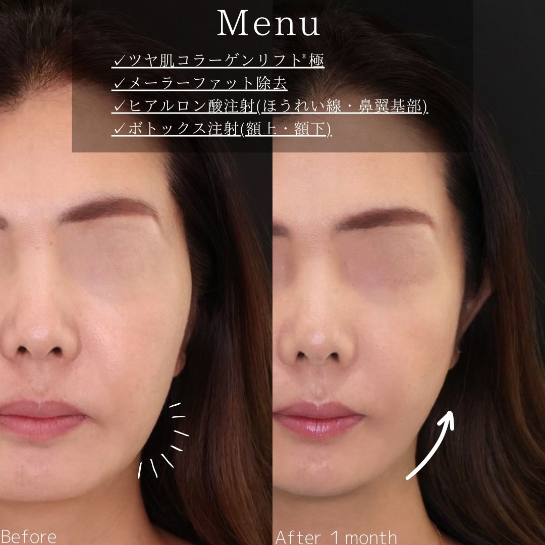 TAC式 ツヤ肌コラーゲンリフト®/メーラーファット除去/ほうれい線のヒアルロン酸注射の症例写真 施術前後 