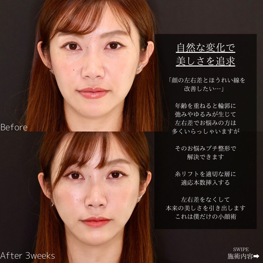 TAC式 ツヤ肌コラーゲンリフト®/ほうれい線のヒアルロン酸注射の症例写真 施術前後 