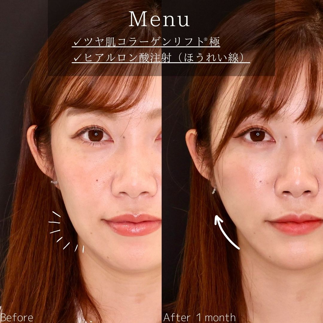 TAC式 ツヤ肌コラーゲンリフト®/ほうれい線のヒアルロン酸注射の症例写真 施術前後 