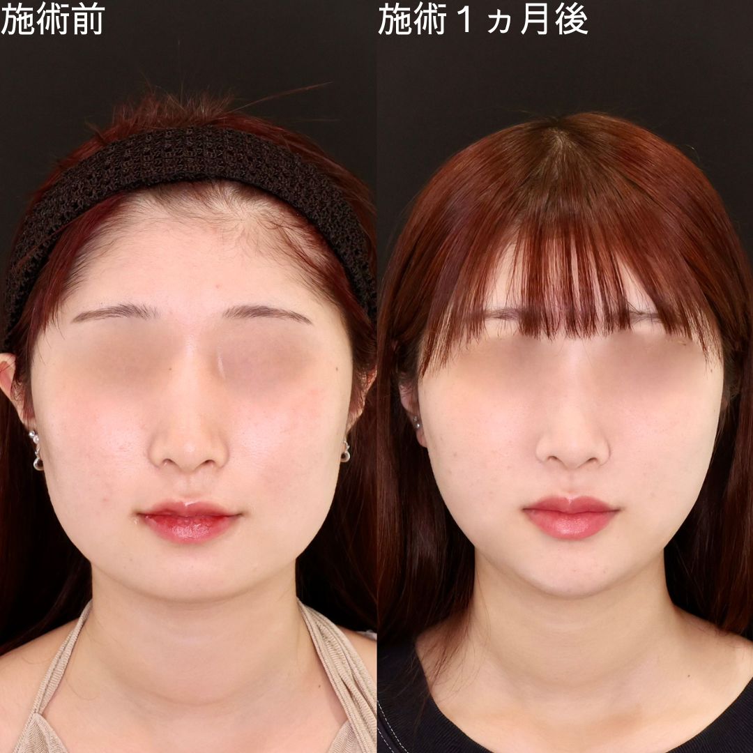 【小顔複合施術】Dr.石橋の最速顔痩せ術