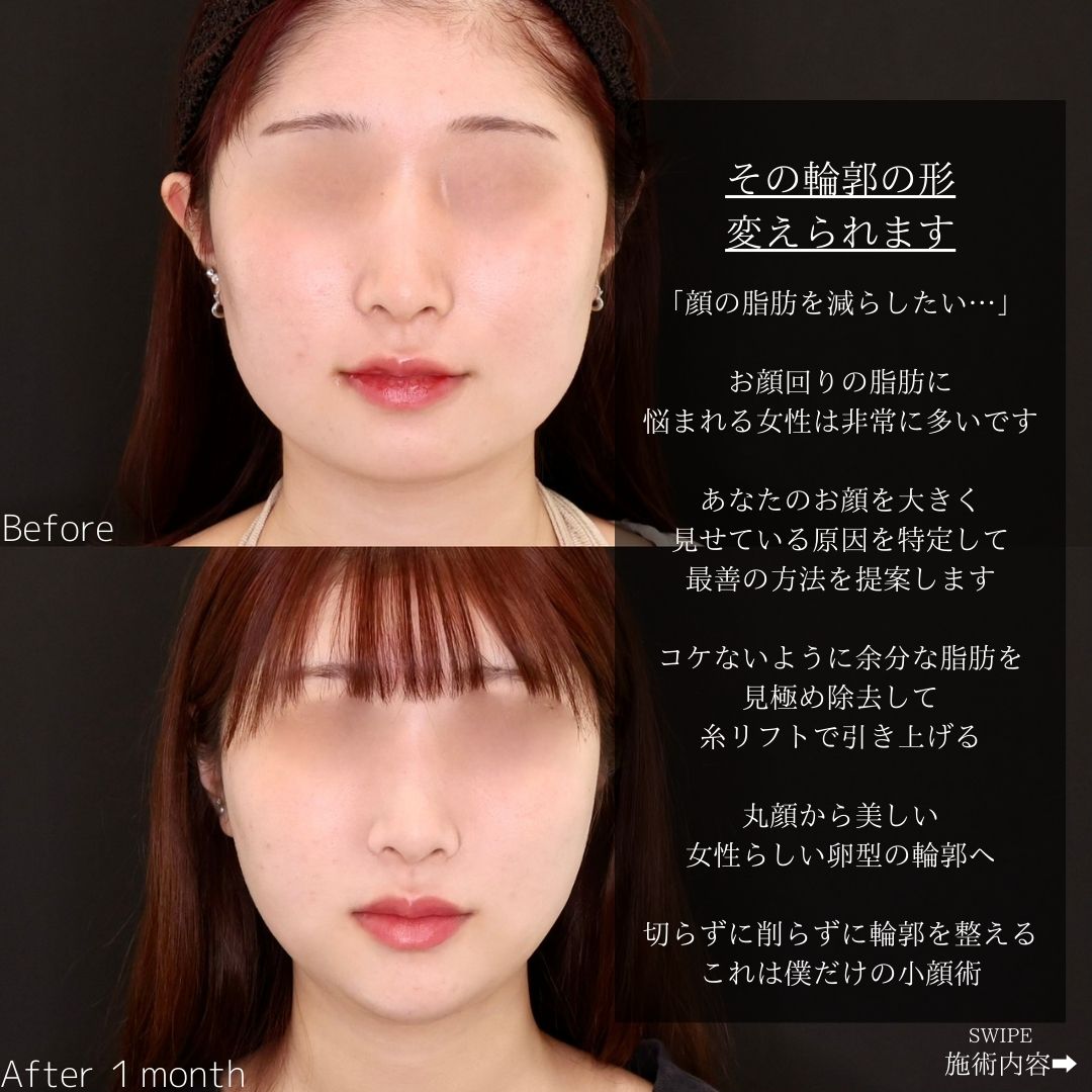 TAC式 ツヤ肌コラーゲンリフト®/顔の脂肪吸引/顎のヒアルロン酸注射の症例写真 施術前後 