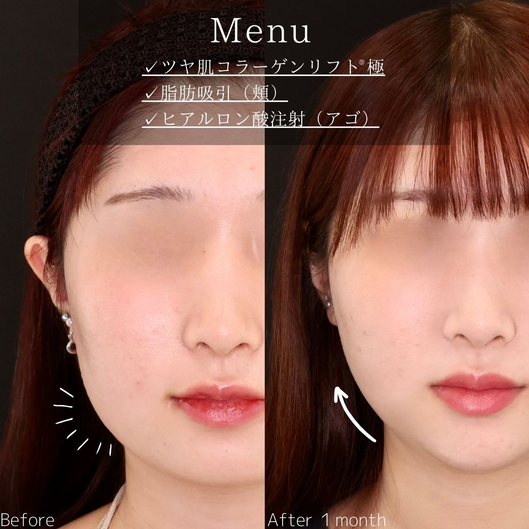 TAC式 ツヤ肌コラーゲンリフト®/顔の脂肪吸引/顎のヒアルロン酸注射の症例写真 施術前後 
