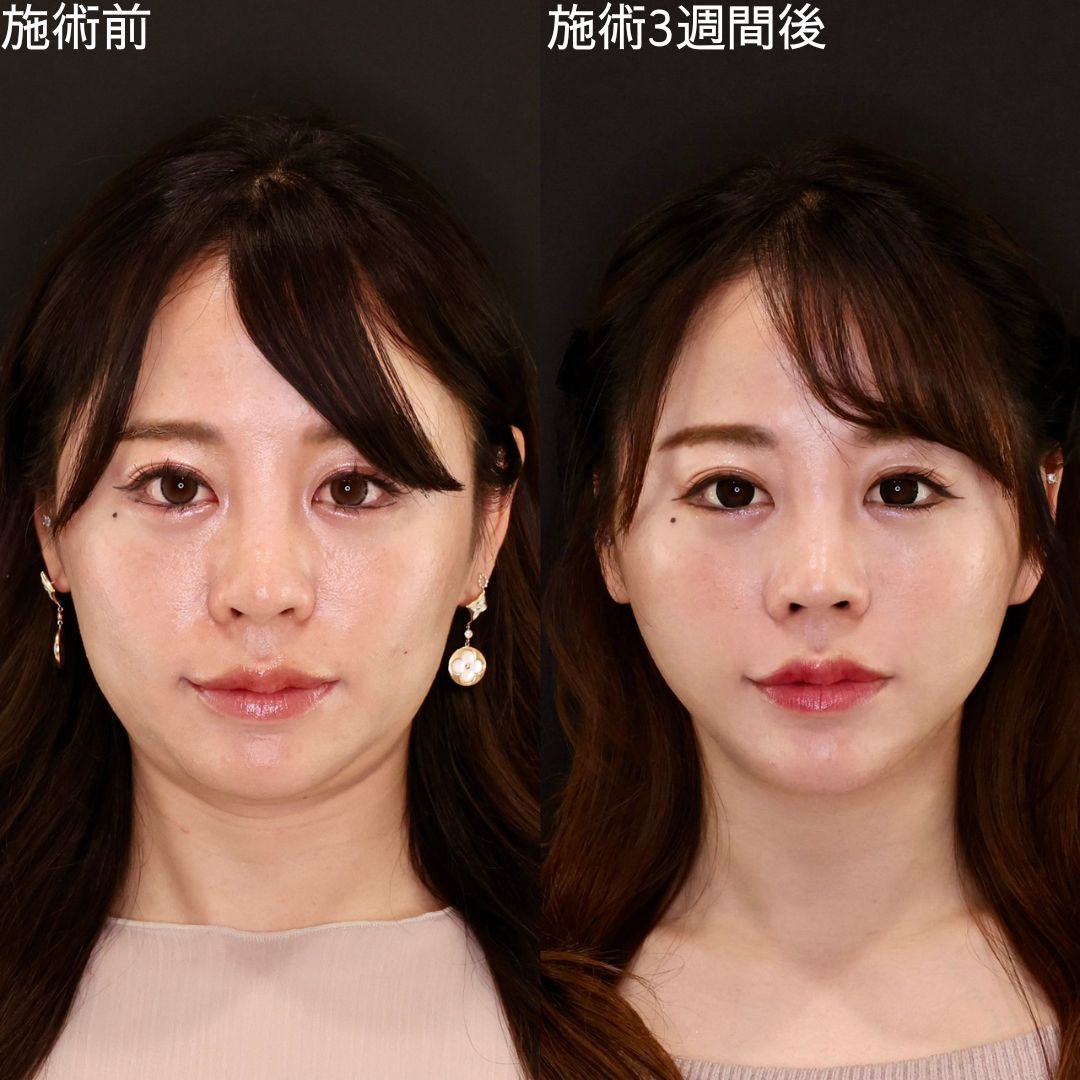 【小顔複合施術】パーツを際立たせる垢抜け小顔術