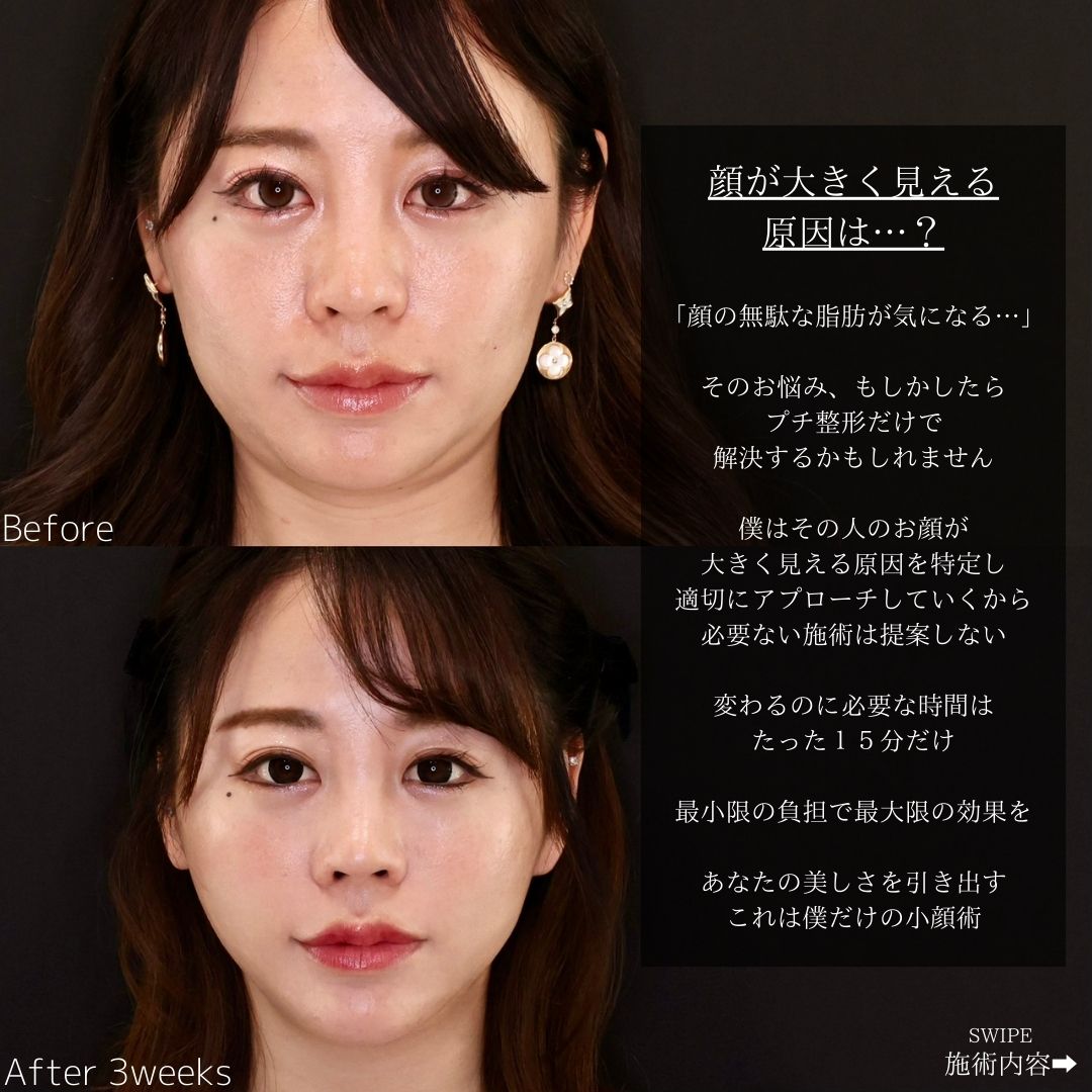 TAC式 ツヤ肌コラーゲンリフト®/顎のヒアルロン酸注射/エラボトックス注射の症例写真 施術前後 