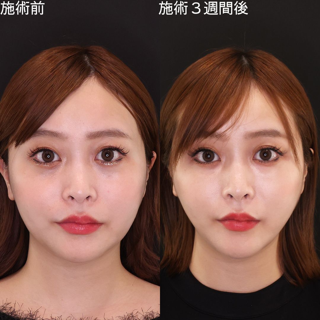 【糸リフト】口横のもたつきを改善して輪郭を洗練