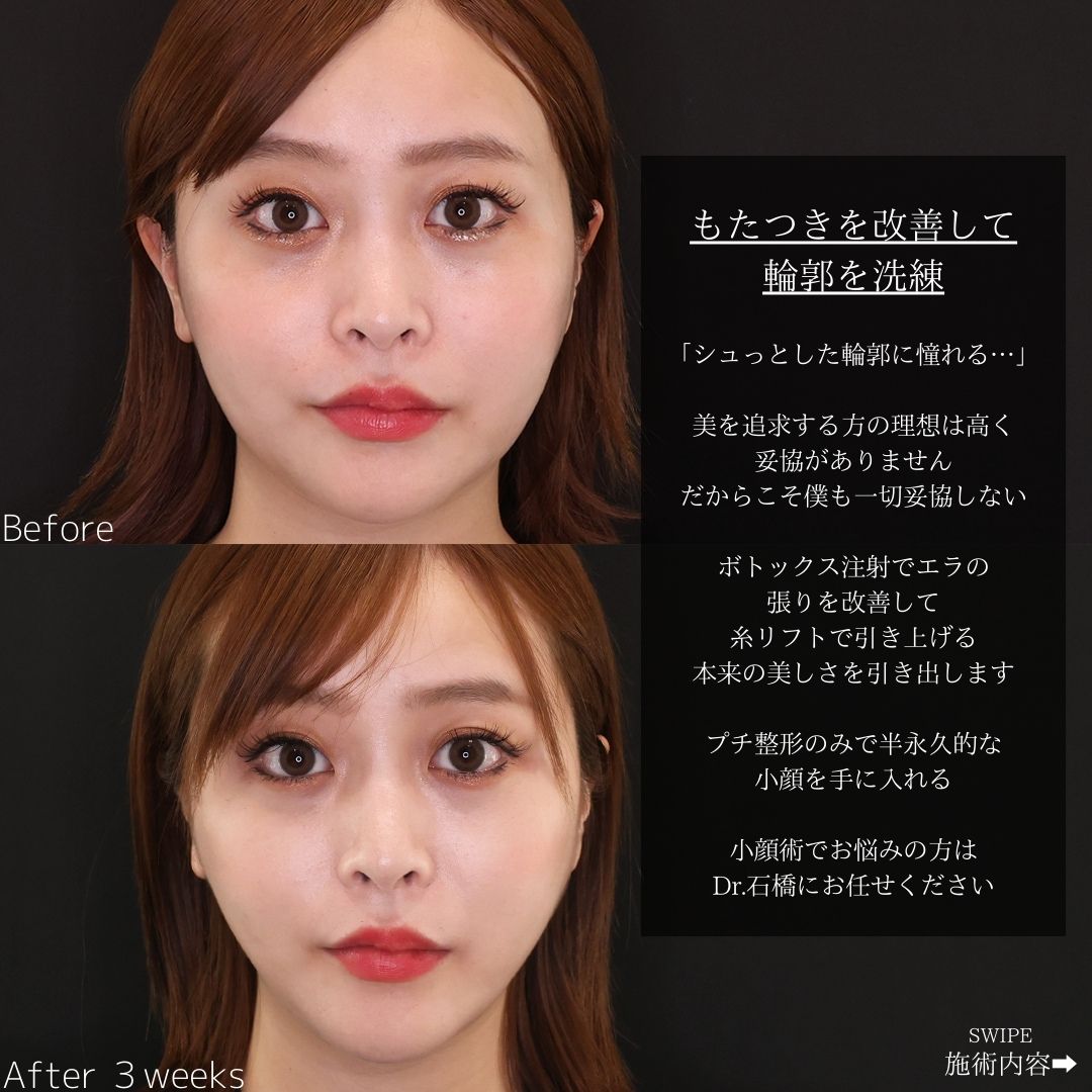 TAC式 ツヤ肌コラーゲンリフト®/エラボトックス注射の症例写真 施術前後 