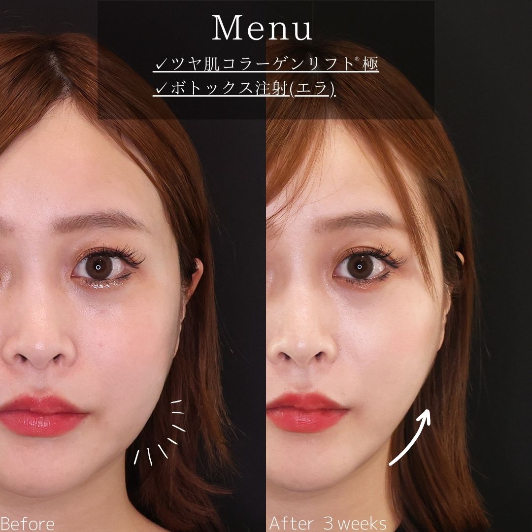 TAC式 ツヤ肌コラーゲンリフト®/エラボトックス注射の症例写真 施術前後 