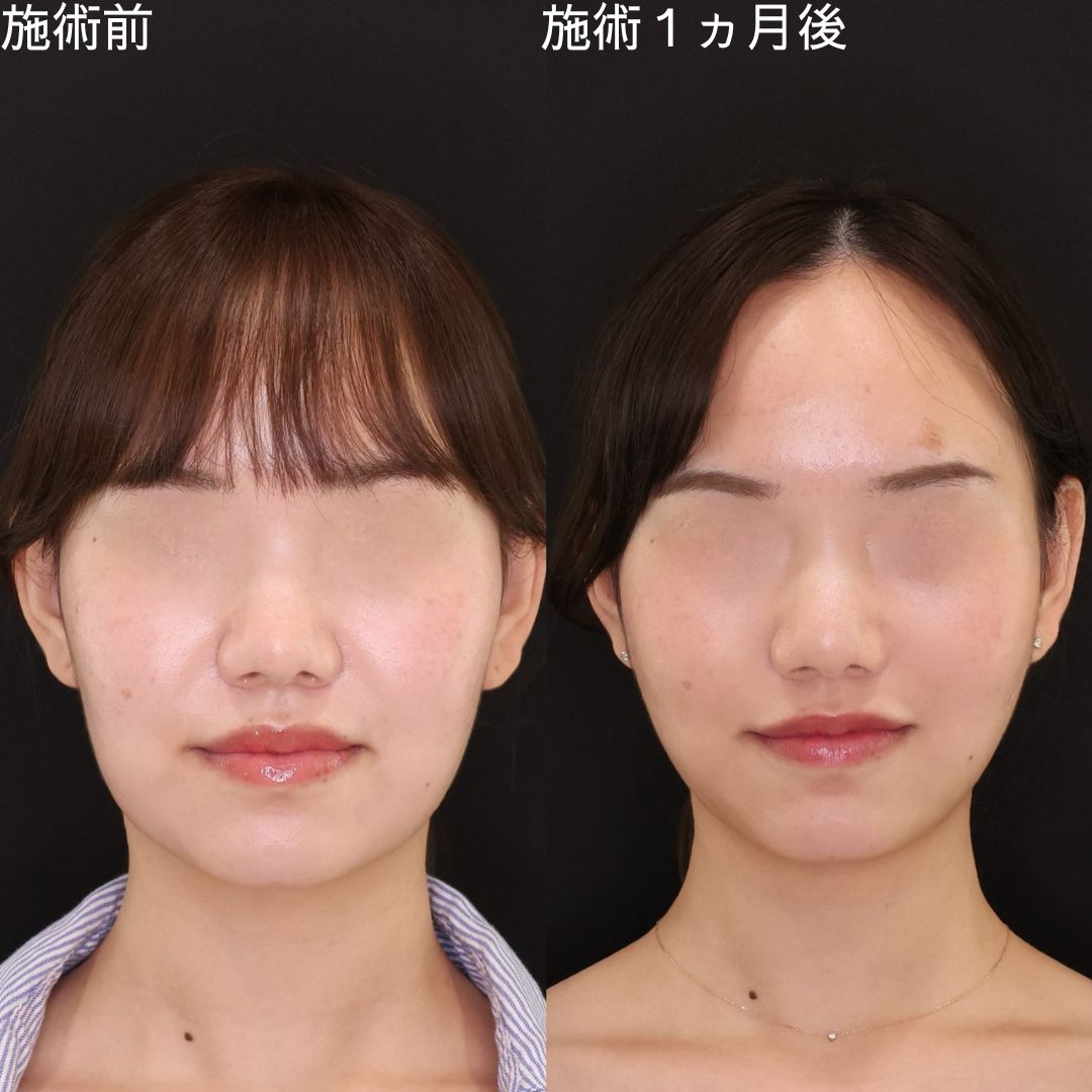 【小顔複合術】輪郭の変化で印象激変！女優級小顔術