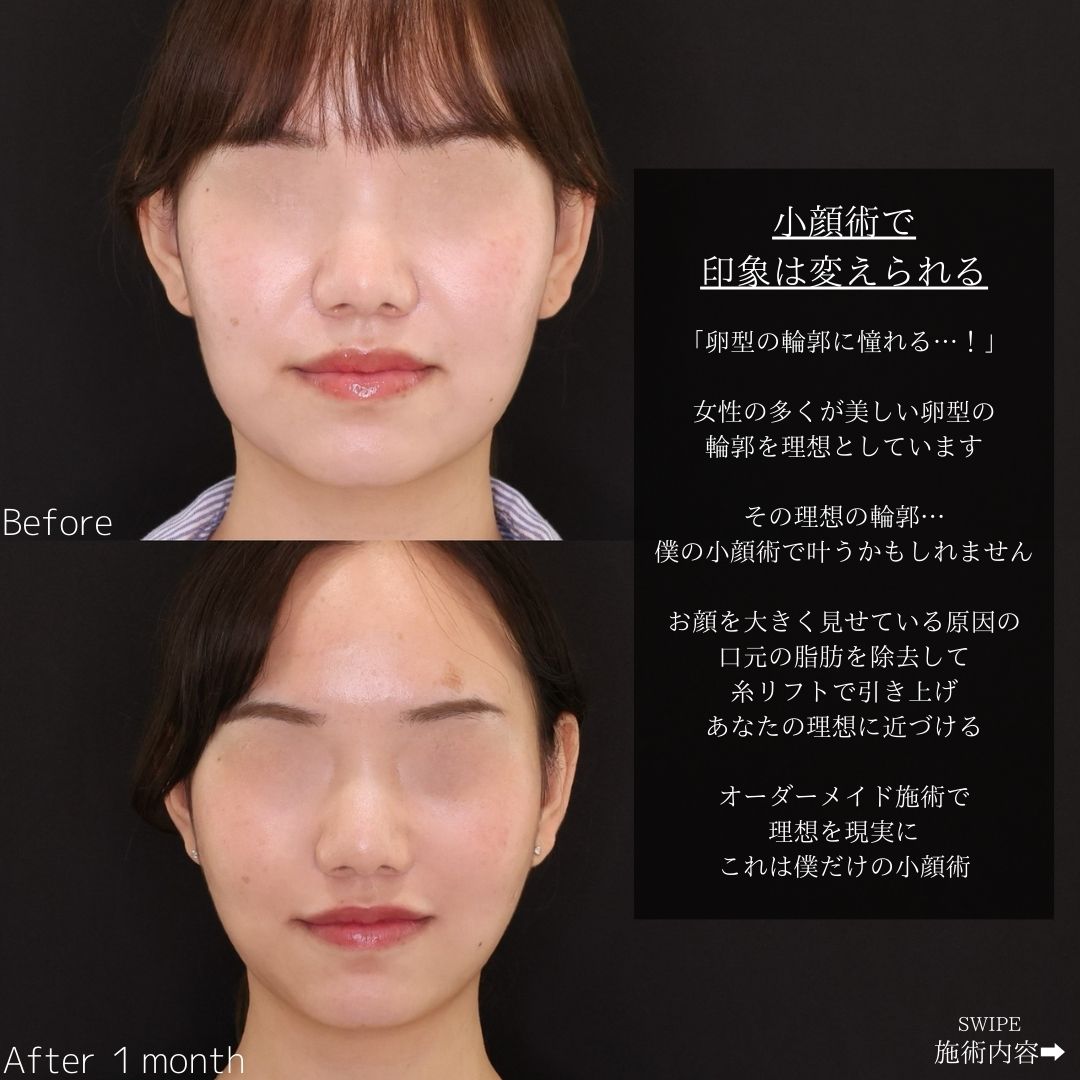 TAC式 ツヤ肌コラーゲンリフト®/ジョールファット除去の症例写真 施術前後 