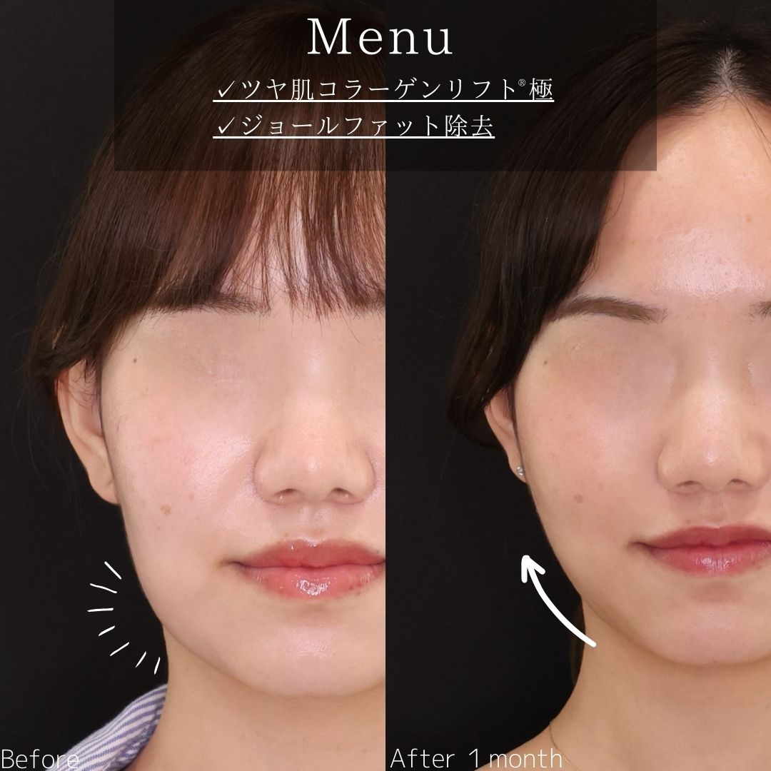 TAC式 ツヤ肌コラーゲンリフト®/ジョールファット除去の症例写真 施術前後 