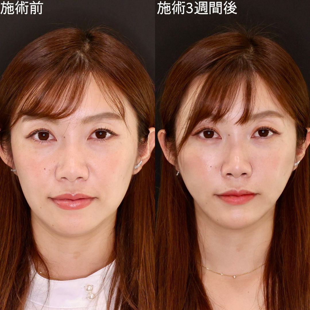 【糸リフト】ナチュラルな変化で確実に垢抜ける小顔術