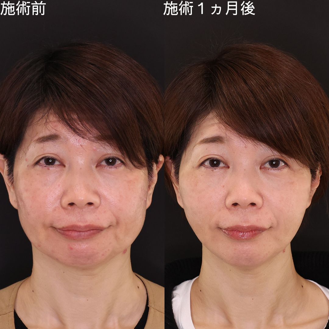 【糸リフト】Dr.石橋 弛み０の若返り小顔術