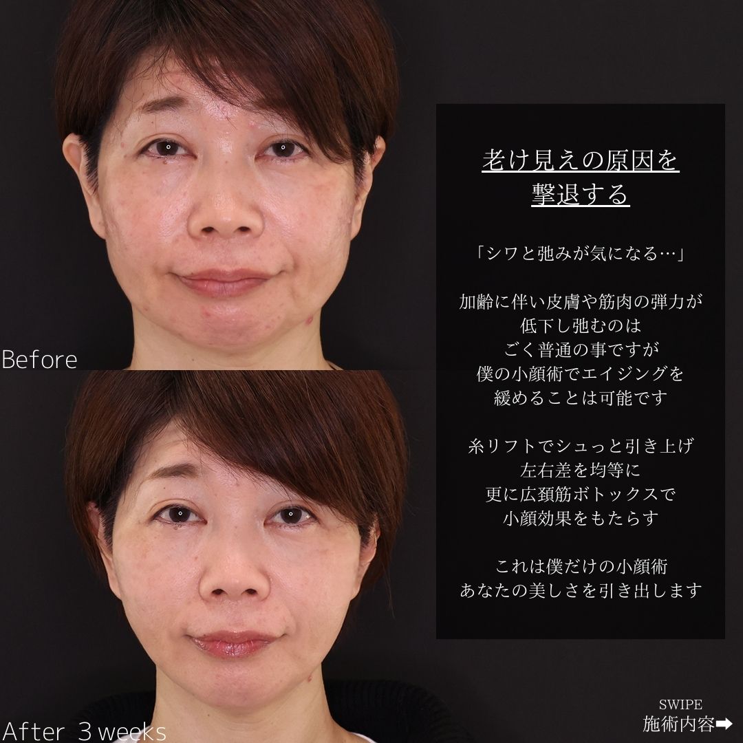 TAC式 ツヤ肌コラーゲンリフト®/ボトックス注射：その他の症例写真 施術前後 