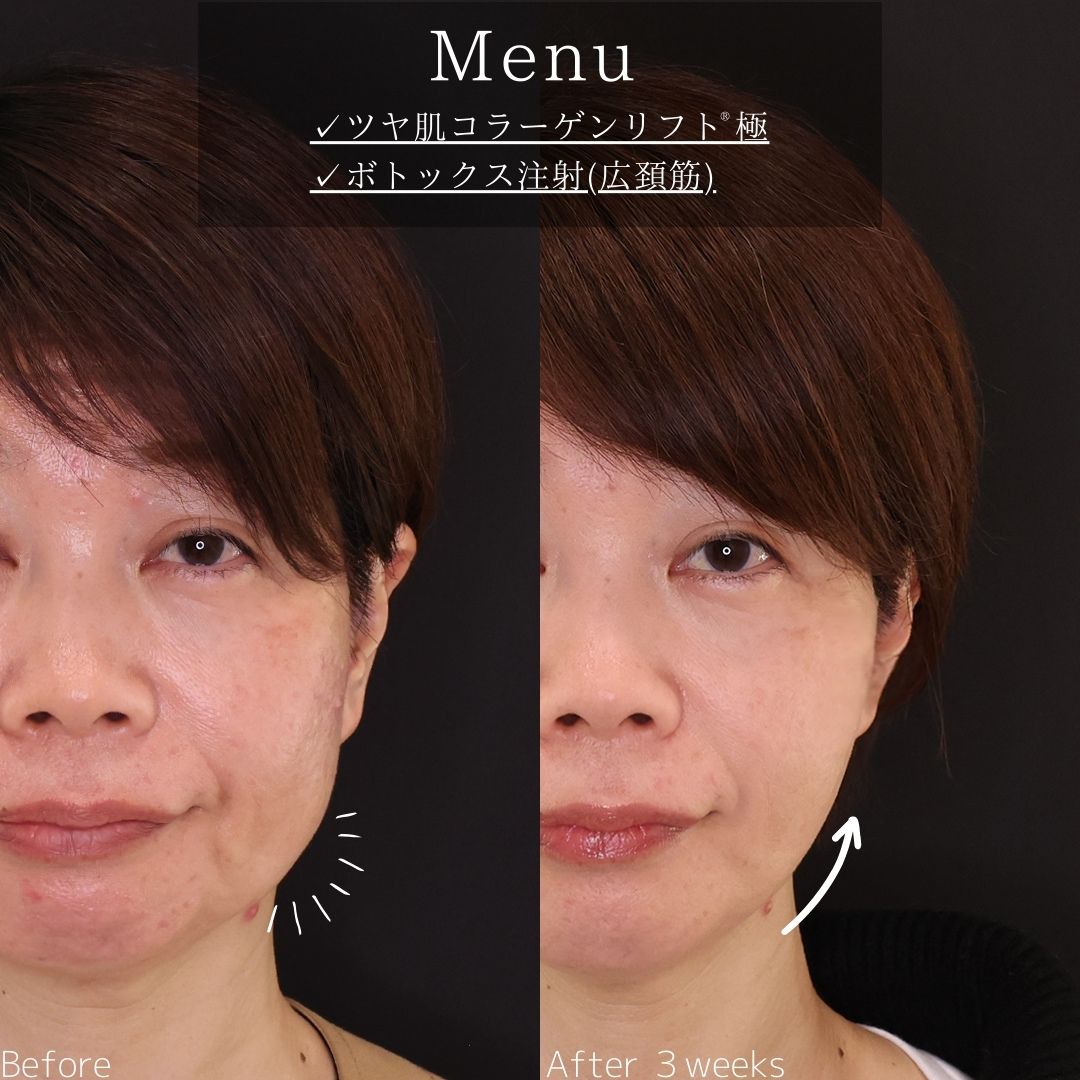 TAC式 ツヤ肌コラーゲンリフト®/ボトックス注射：その他の症例写真 施術前後 