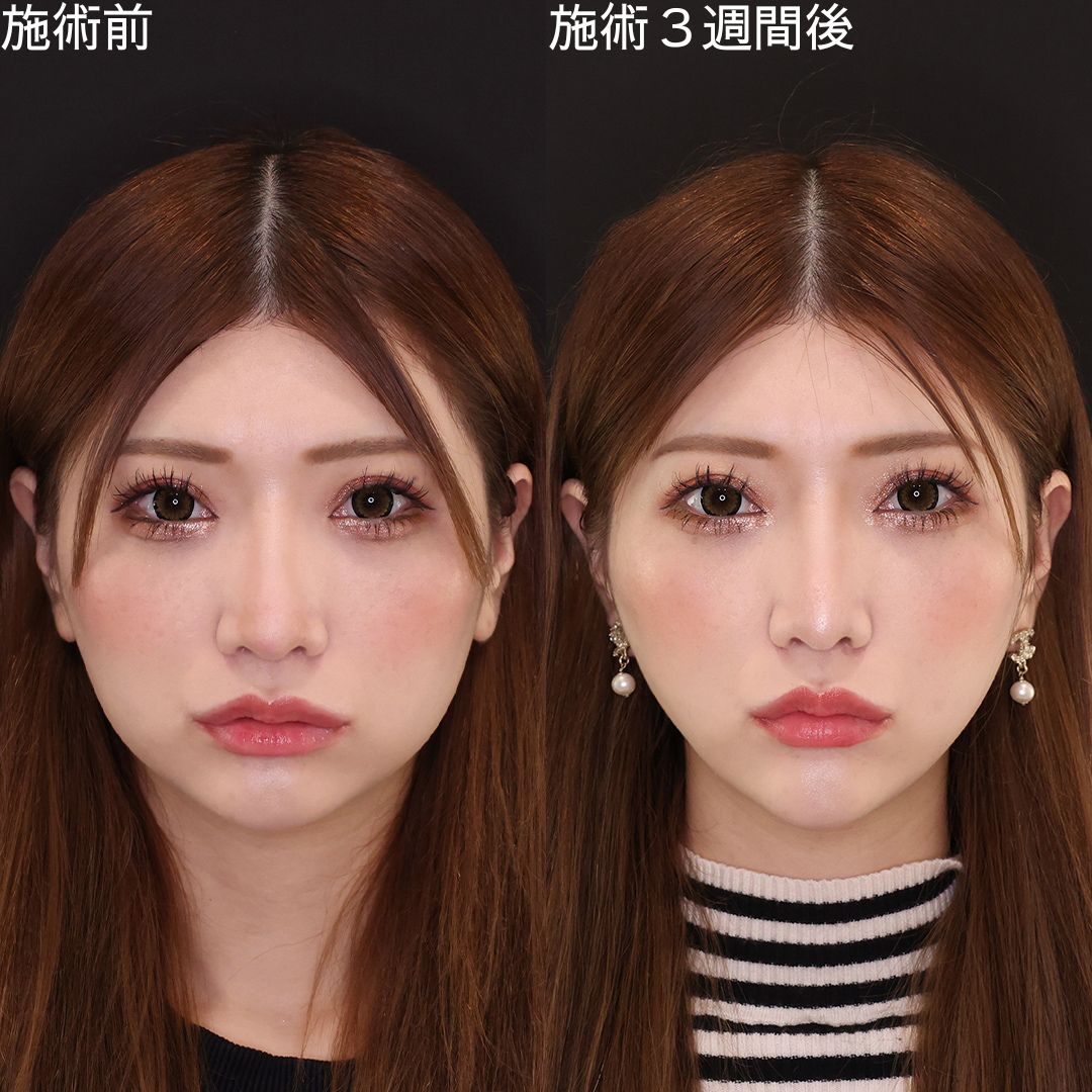 【糸リフト】Dr.石橋の加工アプリ級の小顔術