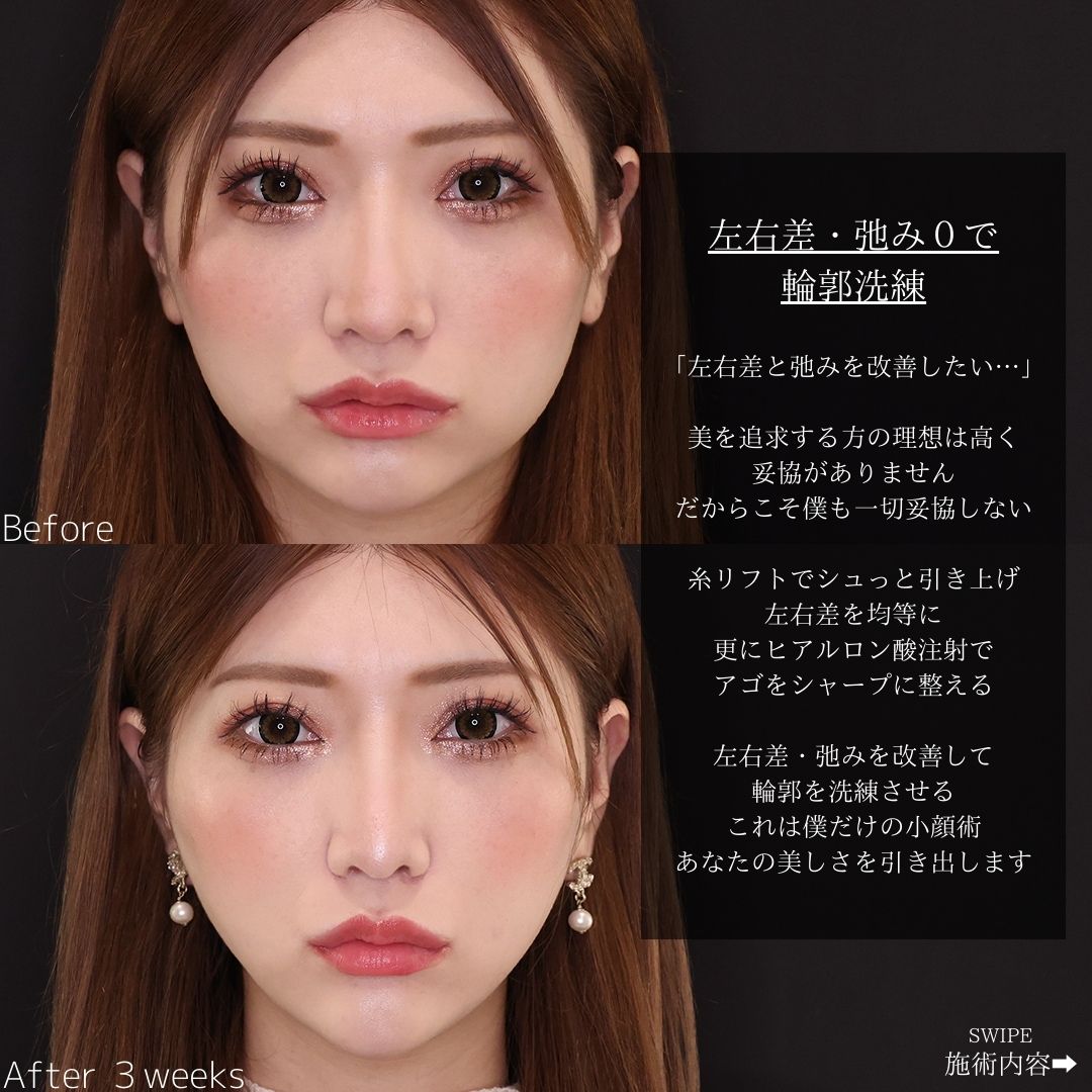 TAC式 ツヤ肌コラーゲンリフト®/エラボトックス注射の症例写真 施術前後 