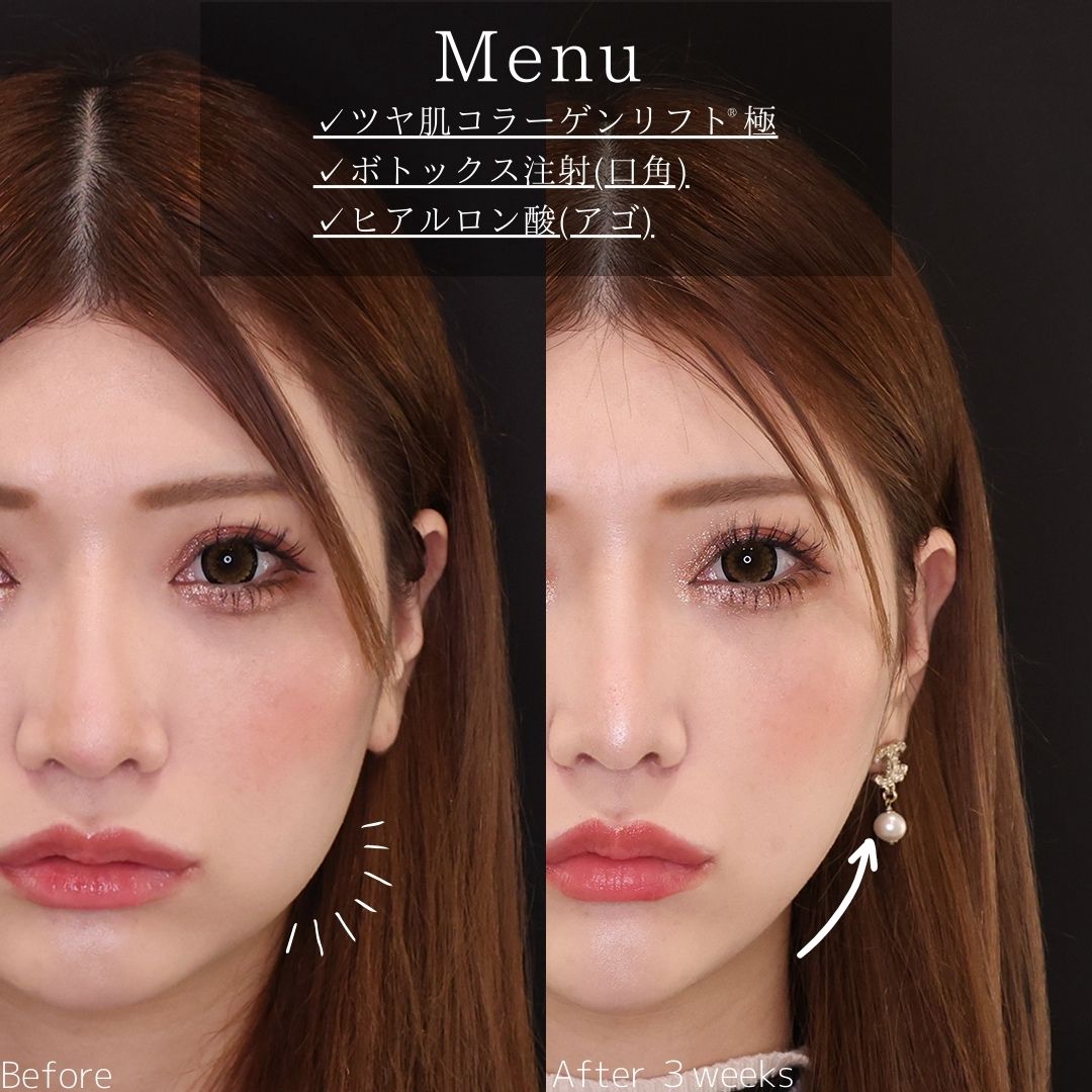 TAC式 ツヤ肌コラーゲンリフト®/エラボトックス注射の症例写真 施術前後 