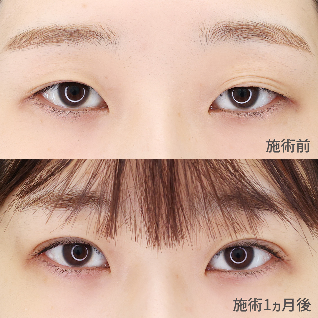 左右不揃いだった目元の悩みがスッキリ解消