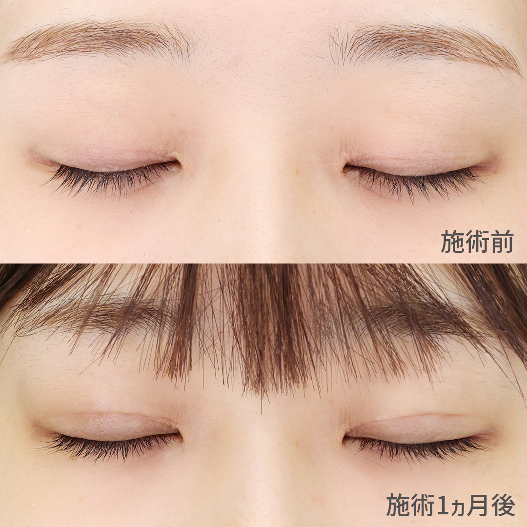 二重埋没法の症例写真 施術前後 