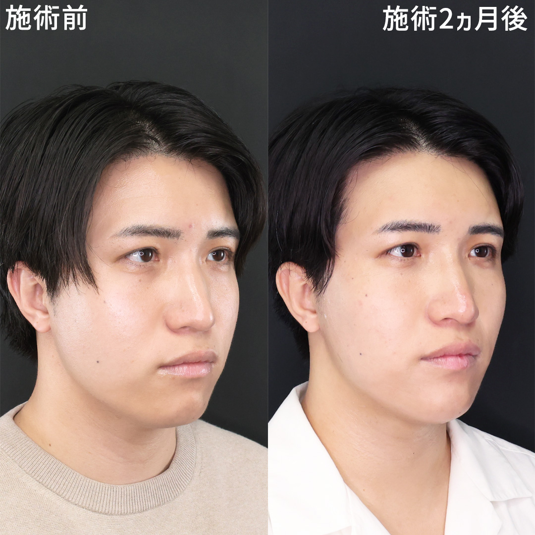 メンズ垢抜け術《クマ取り×小顔》