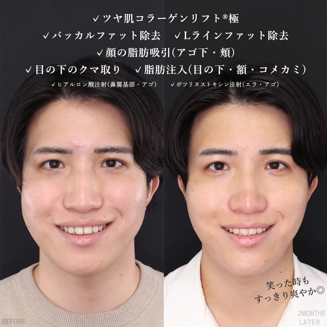 TAC式 ツヤ肌コラーゲンリフト®/バッカルファット除去/Lラインファット除去（エラ下脂肪除去）の症例写真 施術前後 