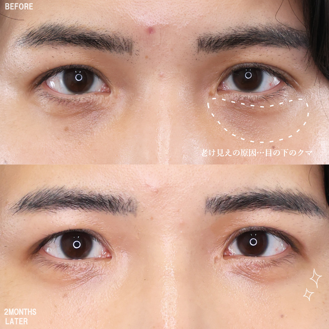 TAC式 ツヤ肌コラーゲンリフト®/バッカルファット除去/Lラインファット除去（エラ下脂肪除去）の症例写真 施術前後 