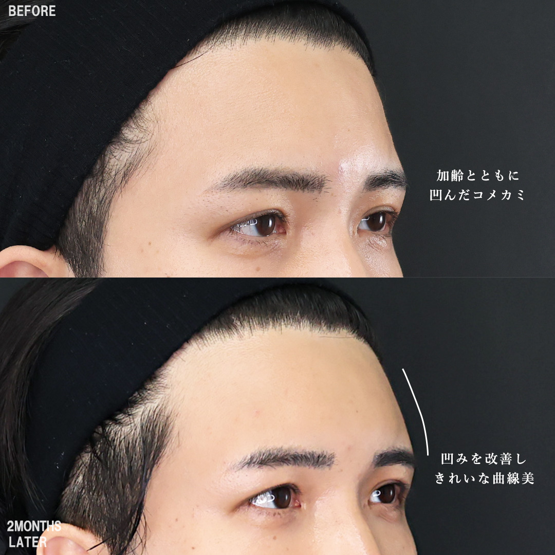 TAC式 ツヤ肌コラーゲンリフト®/バッカルファット除去/Lラインファット除去（エラ下脂肪除去）の症例写真 施術前後 