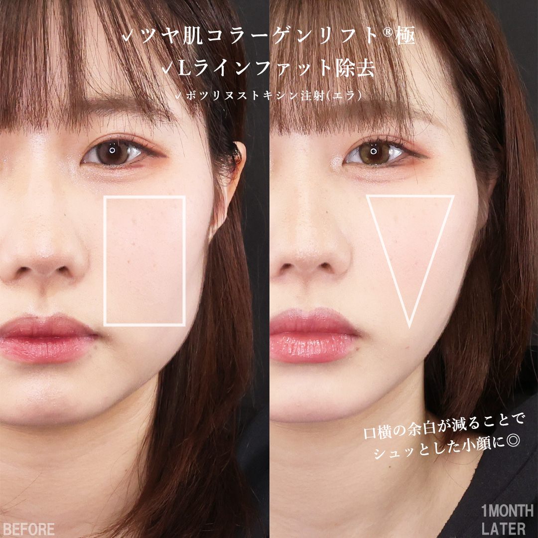 TAC式 ツヤ肌コラーゲンリフト®/Lラインファット除去（エラ下脂肪除去）/エラボトックス注射の症例写真 施術前後 