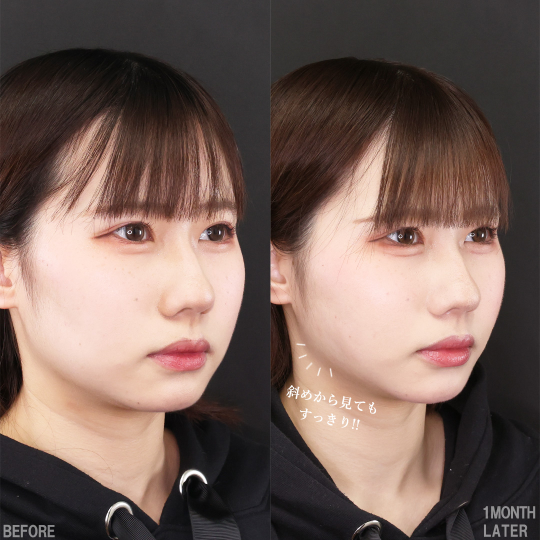 TAC式 ツヤ肌コラーゲンリフト®/Lラインファット除去（エラ下脂肪除去）/エラボトックス注射の症例写真 施術前後 