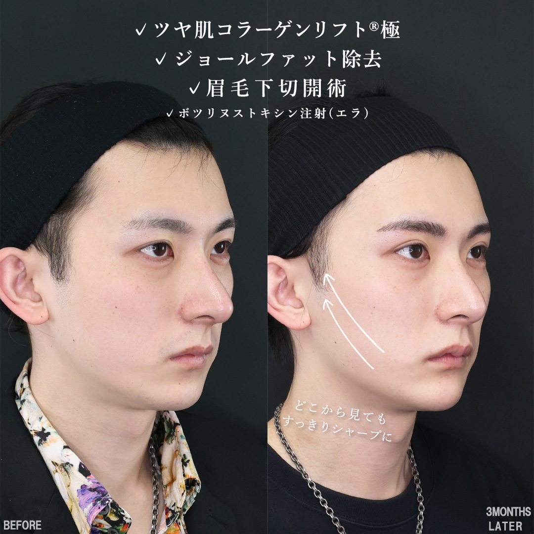 TAC式 ツヤ肌コラーゲンリフト®/ジョールファット除去/眉毛下切開術の症例写真 施術前後 