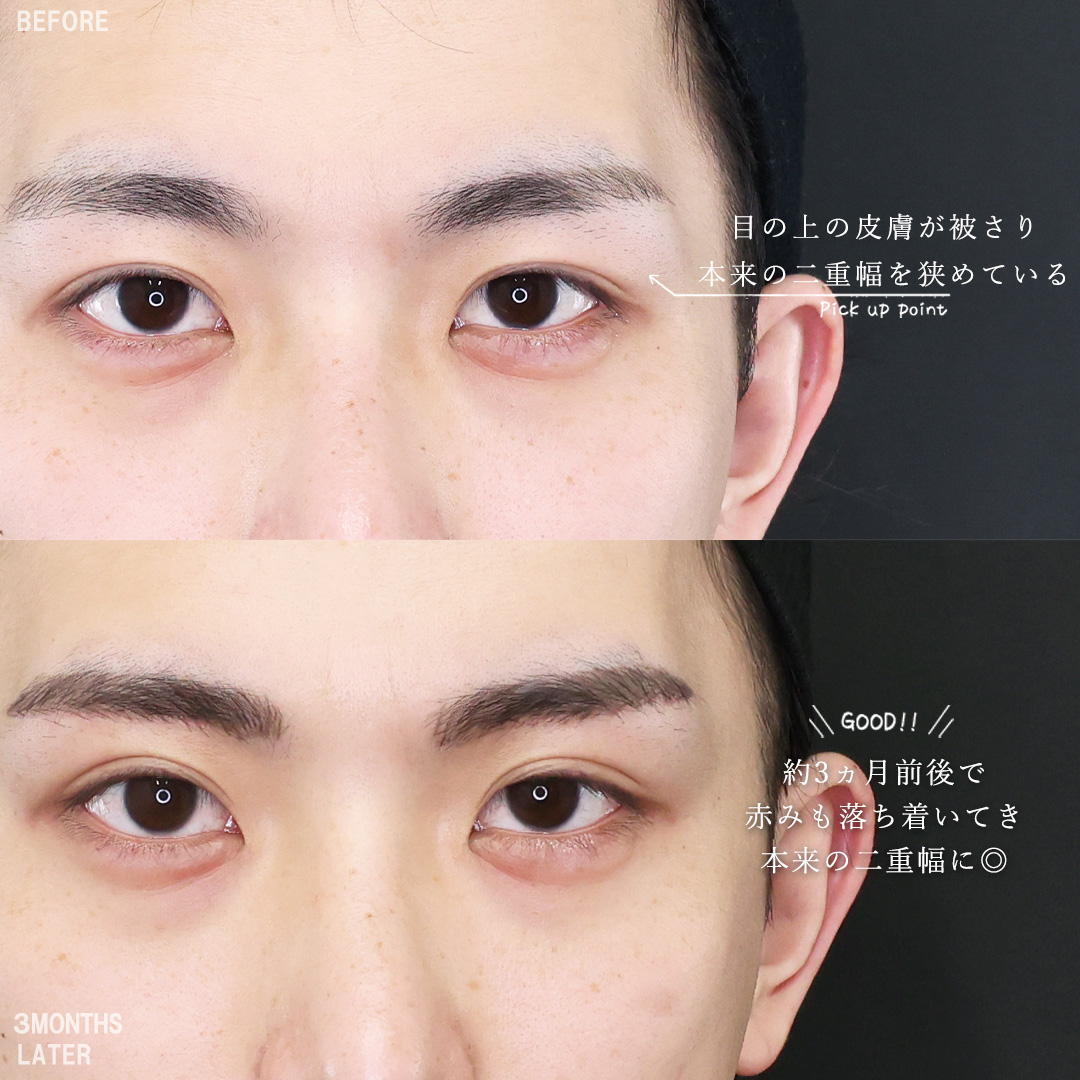 TAC式 ツヤ肌コラーゲンリフト®/ジョールファット除去/眉毛下切開術の症例写真 施術前後 