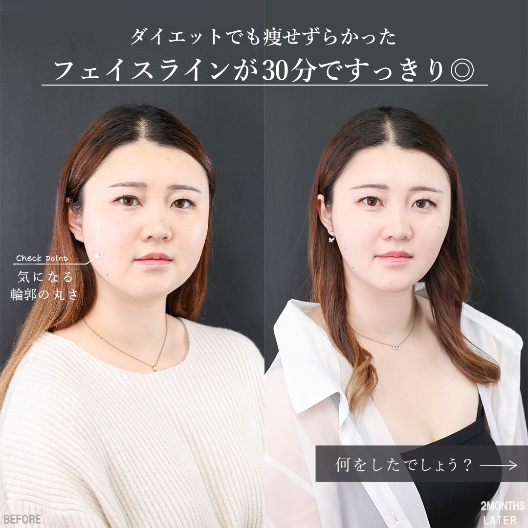 TAC式 ツヤ肌コラーゲンリフト®/バッカルファット除去/Lラインファット除去（エラ下脂肪除去）の症例写真 施術前後 