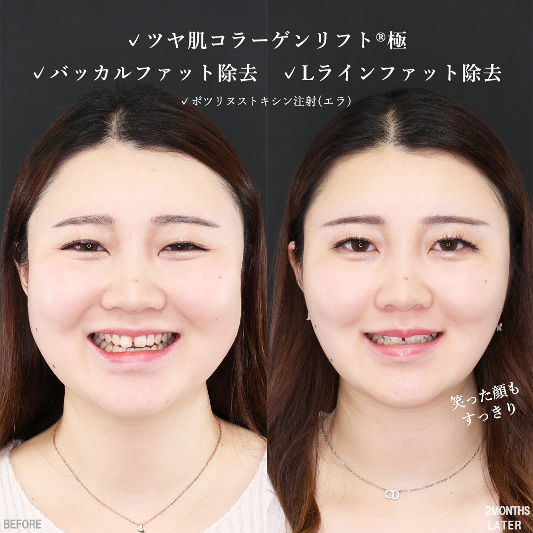 TAC式 ツヤ肌コラーゲンリフト®/バッカルファット除去/Lラインファット除去（エラ下脂肪除去）の症例写真 施術前後 