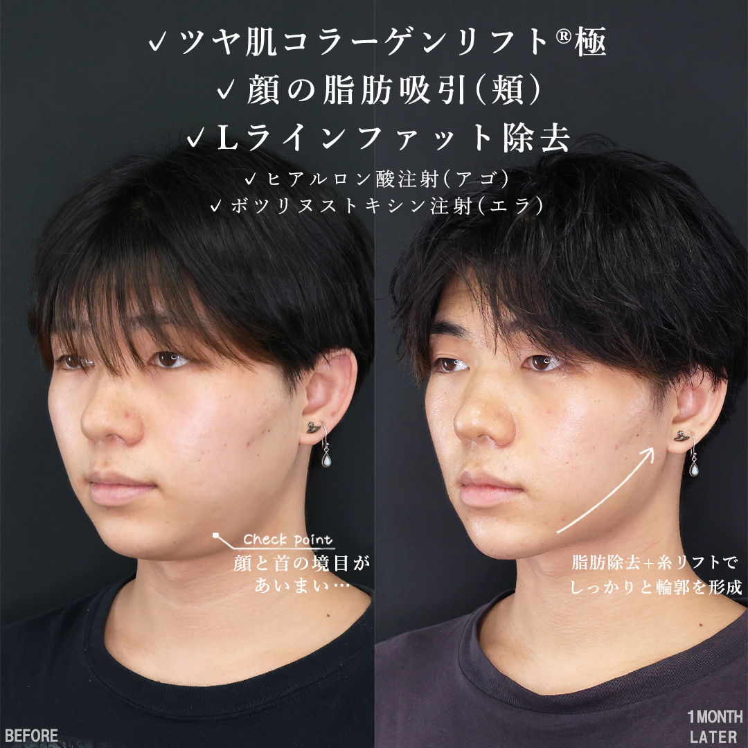 TAC式 ツヤ肌コラーゲンリフト®/顔の脂肪吸引/Lラインファット除去（エラ下脂肪除去）の症例写真 施術前後 