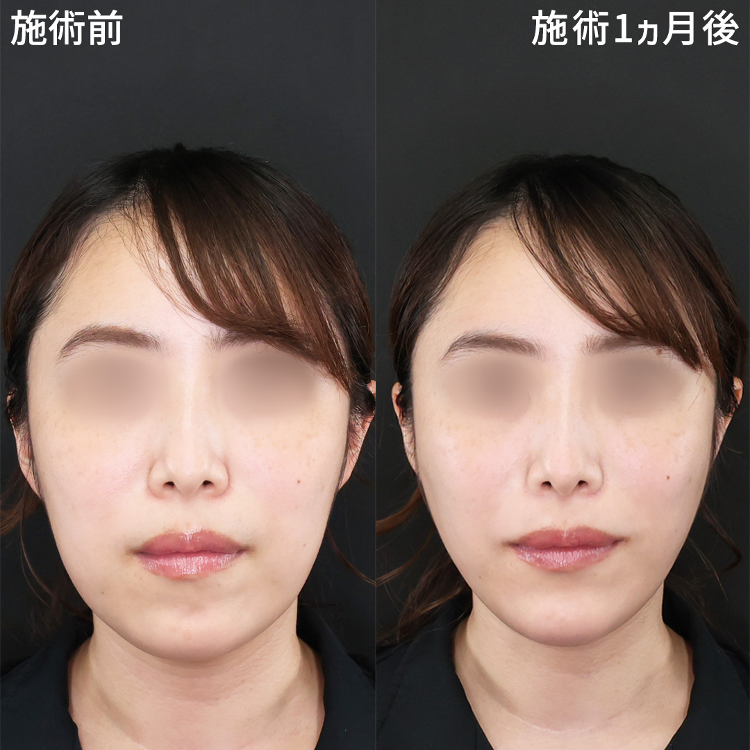 【二重顎も改善】気になるお顔の脂肪を取り、理想の小顔へ