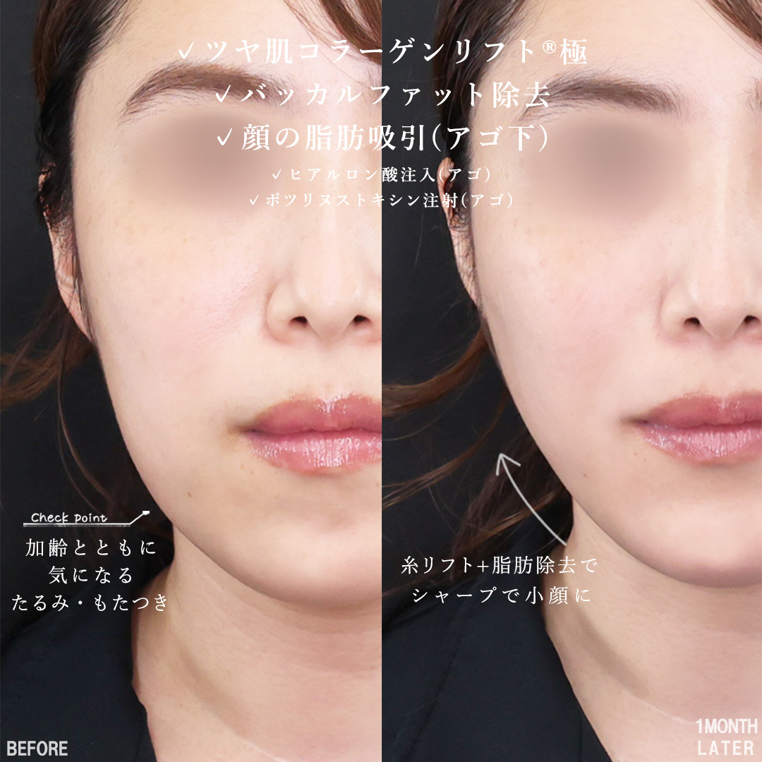 TAC式 ツヤ肌コラーゲンリフト®/バッカルファット除去/顔の脂肪吸引の症例写真 施術前後 