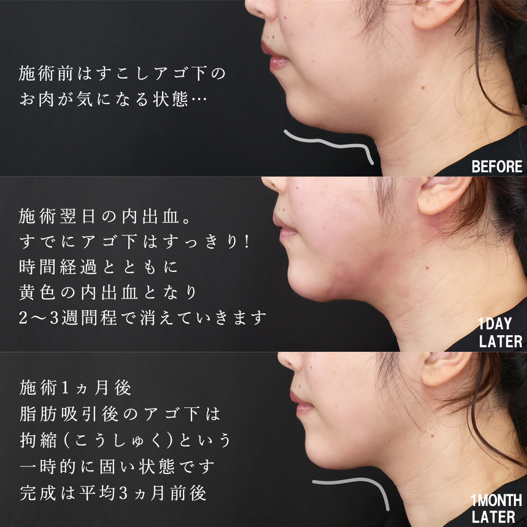 TAC式 ツヤ肌コラーゲンリフト®/バッカルファット除去/顔の脂肪吸引の症例写真 施術前後 