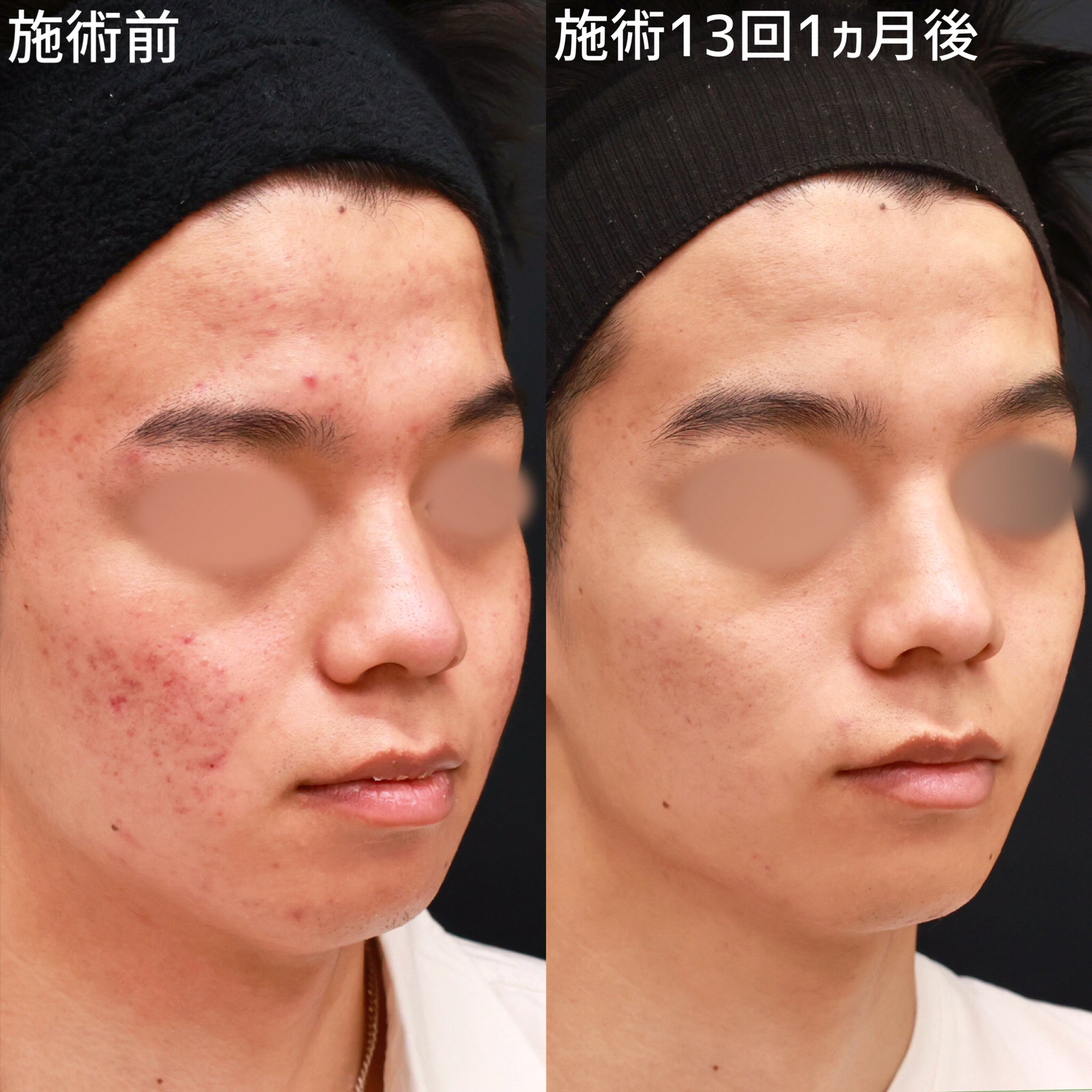 ダーマペン4/エクソソーム/ベルベットスキンの症例写真 施術前後 