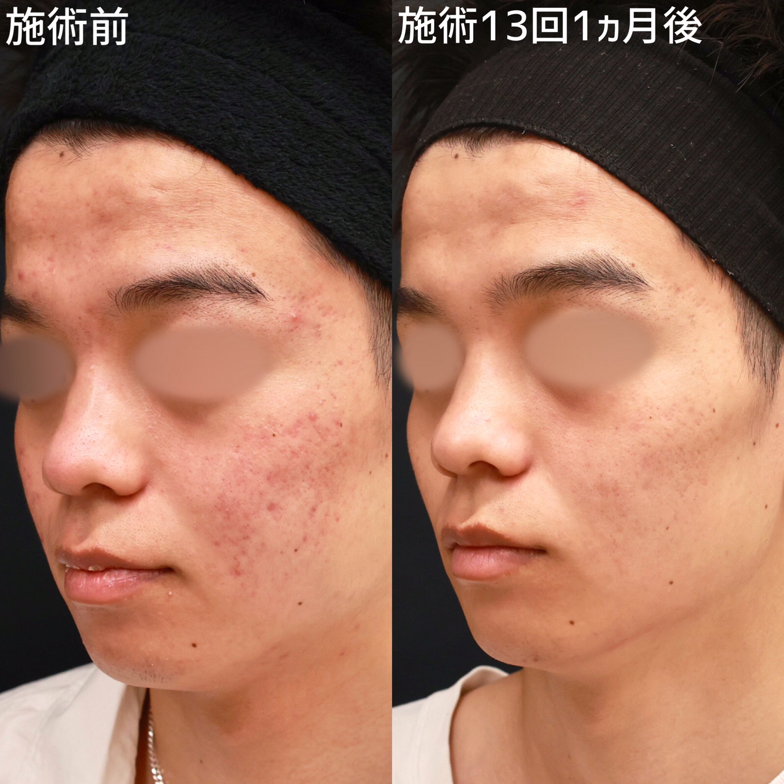 ダーマペン4/エクソソーム/ベルベットスキンの症例写真 施術前後 